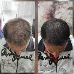 Tattoo micropigmentación